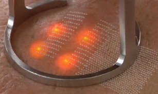 Expozice laserem na kůži